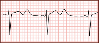 ECG QT, QU interval calculation
