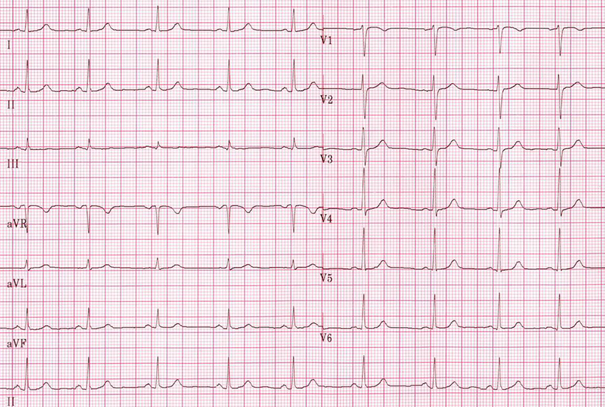 ECG sinus rhythm, heart rate 75bpm, normal P waves