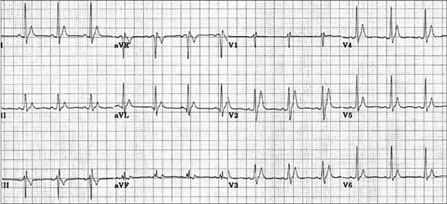 ECG short QT syndrome, type 1
