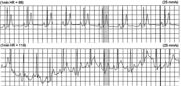 ECG short QT syndrome, and fixed short QT interval, QT remain constant over a range of heart rates