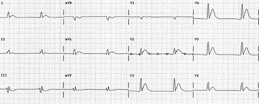 ECG acquired short QT interval, hypercalcemia