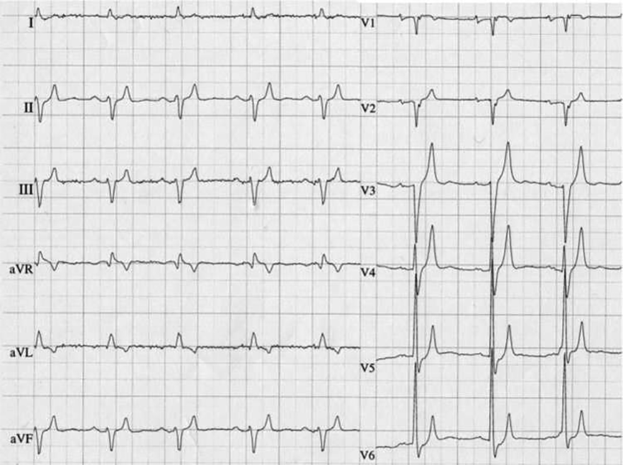 ECG acquired short QT interval, hyperkalemia
