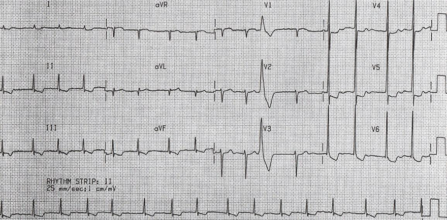 ECG acquired short QT interval, digoxin, atrial fibrillation