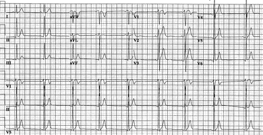 ECG short QT syndrome, type 1 (SQTS1), short QT interval 310ms