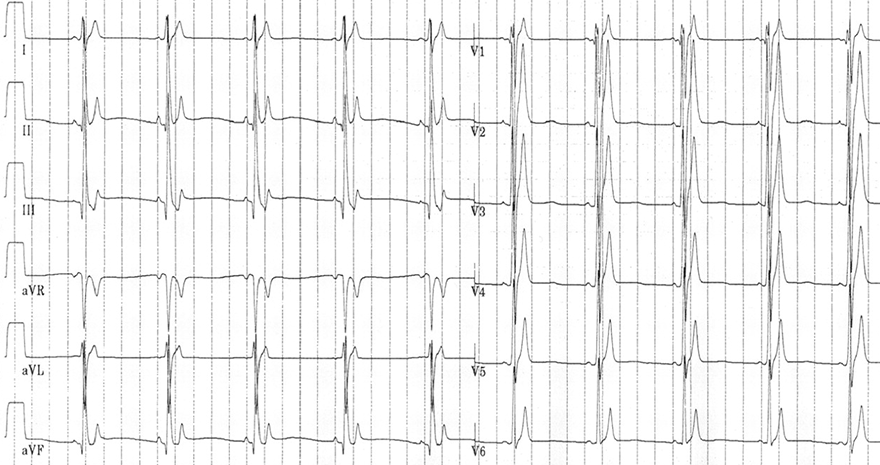 ECG short QT syndrome, SQTS1