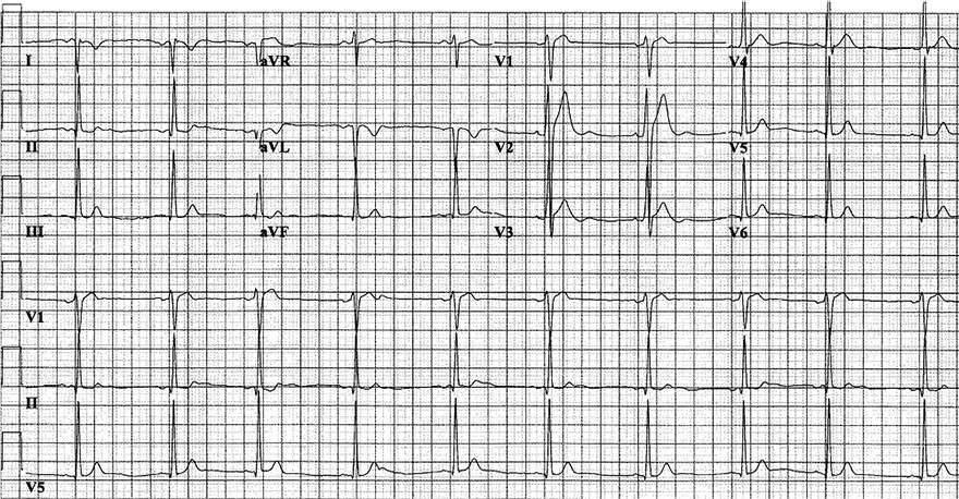 ECG short qt syndrome, type 1. Short QT interval