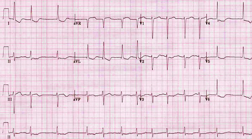 ECG digoxin effect, sagging ST depression