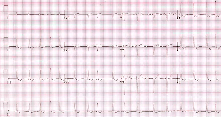 ECG digoxin pattern, downsloping sagging ST depression, short QT interval