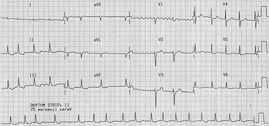 ECG digoxin effect, sagging ST depression, atrial fibrillation