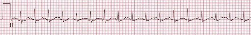 ECG hyperthyroidism, thyrotoxicosis, sinus tachycardia