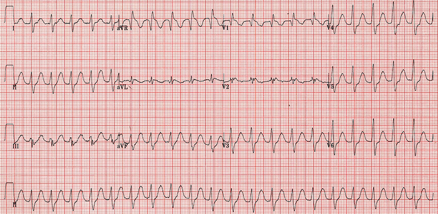 ECG flecainid poisoning, sodium channel blocker toxicity, sinus tachycardia, broad qrs, terminal r aVR