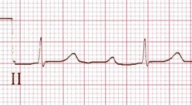 ECG beta blockers toxicity, prolonged PR, 1st first degree av block