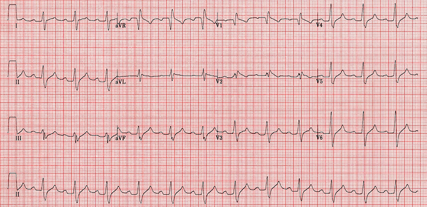 ECG flecainid overdose, first av block, sinus rhythm