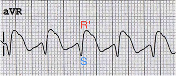 ECG beta blocker propranolol toxicity, positive R wave aVR
