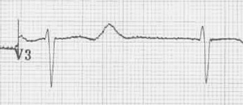 ECG beta blocker sotalol toxicity, overdose, prolongation QT interval, signs of sodium channel blockade