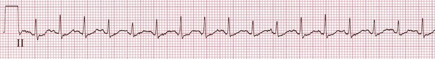 ECG inappropriate sinus tachycardia (IST)