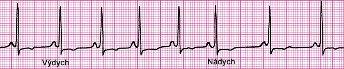 ECG non-respiratory sinus arrhythmia