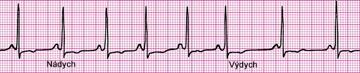 ECG respiratory sinus arrhytmia