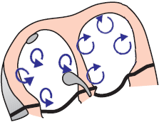 atrial fibrillation, re-entry mechanism
