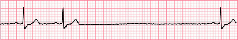 ECG 3rd degree sa block vs. sinus arrest, pause
