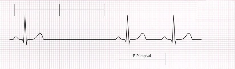 ECG sinus arrest (pause)