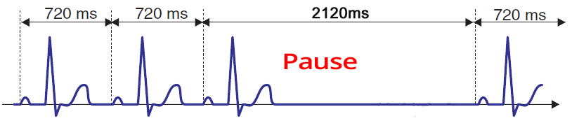 ECG sinus arrest, sinus pause