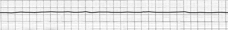 ECG asystole, ECG flatline