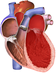 Dilated cardiomyopathy overview