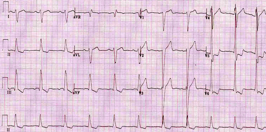 ECG dilated cardiomyopathy, left ventricular hypertrophy, LV strain pattern, biventricular enlargement