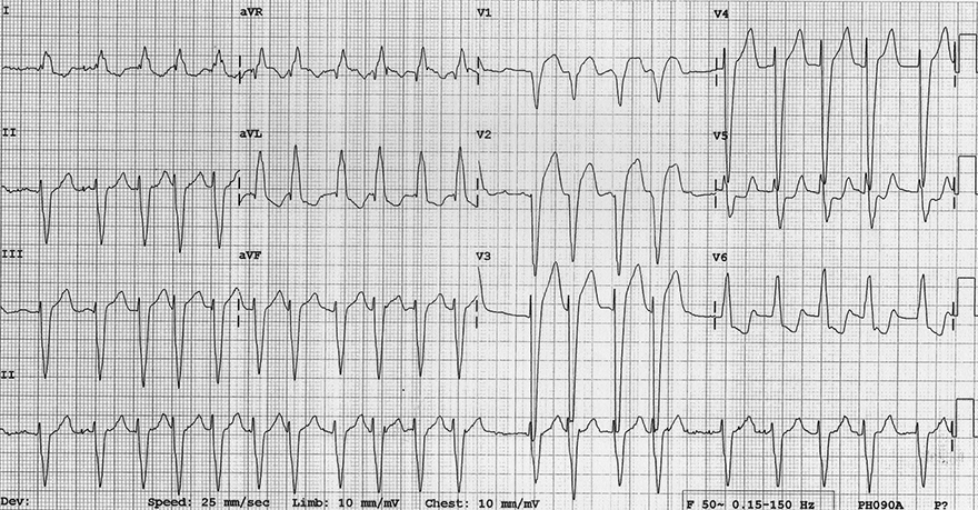 ECG dilated cardiomyopathy, left bundle branch block (LBBB), atrial fibrillation