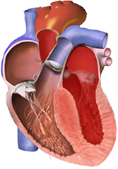 Hypertrophic cardiomyopathy overview