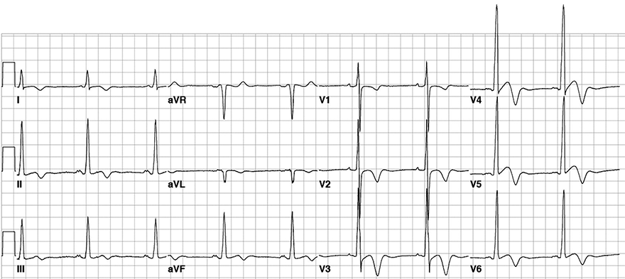 ECG apical hypertrophic cardiomyopathy, large voltage, giant T waves invarsions inferior, lateral leads