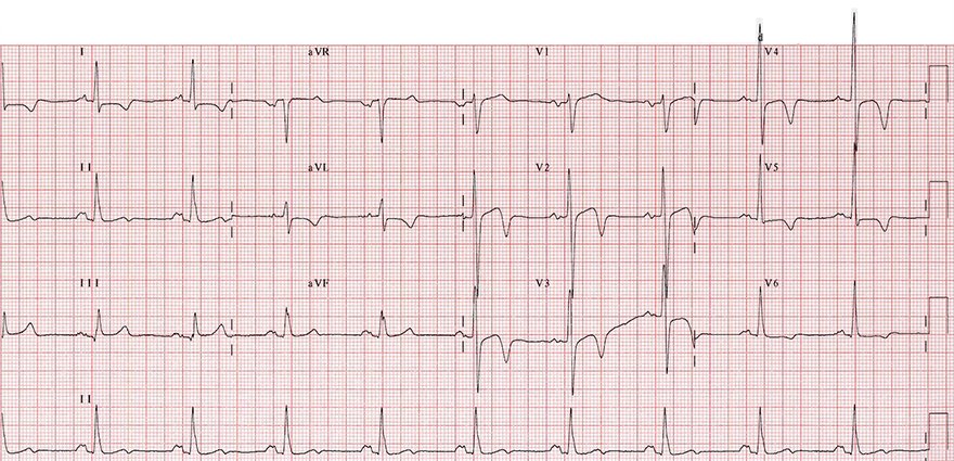 ECG apical hypertrophic cardiomyopathy, left ventricular hypertrophy, P mitrale, deep inverted T waves in laterl leads