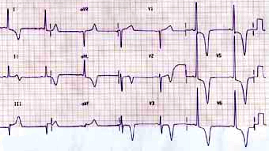 ECG apical hypertrophic cardiomyopathy, giant T-wave inversion in the precordial leads