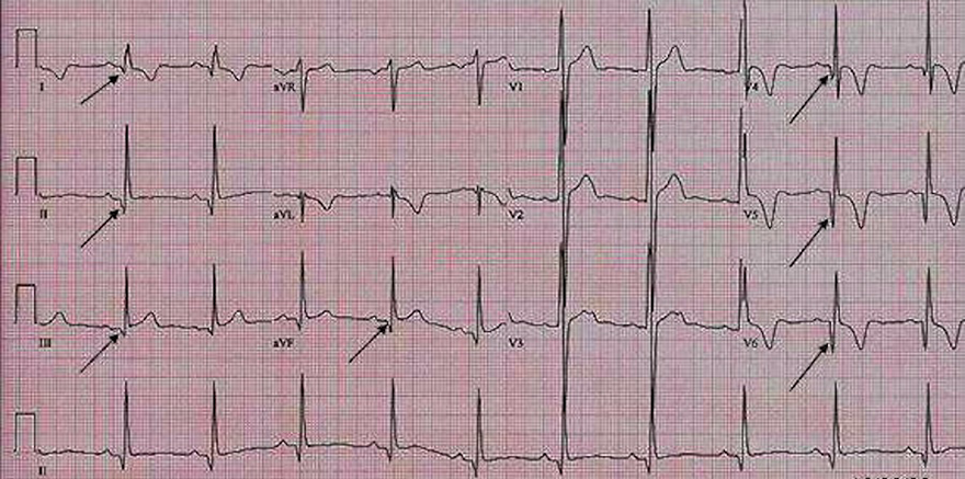 ECG apical hypertrophic cardiomyopathy, deep, narrow dagger-like Q waves