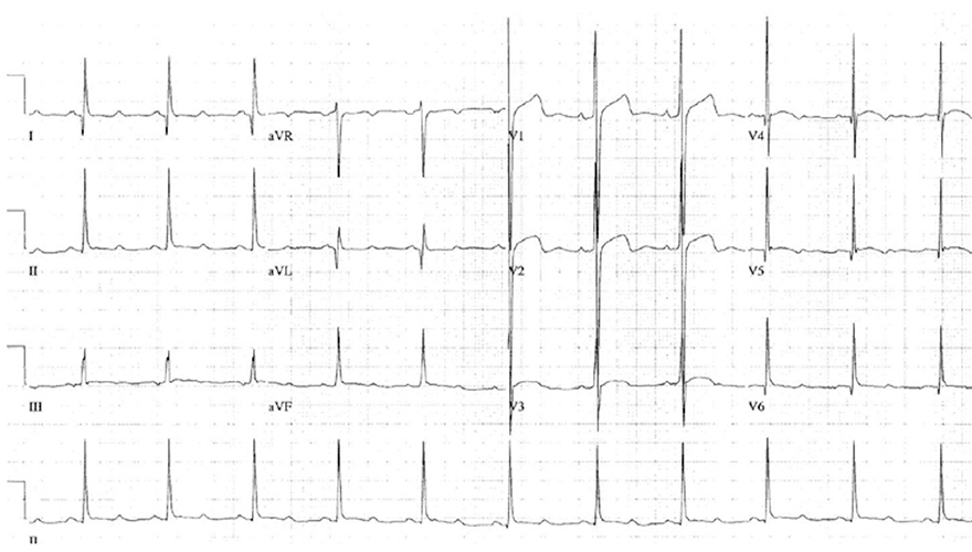 ECG septal hypertrophic obstructive cardiomyopathy, large precordial volgages, deep narrow septal Q waves