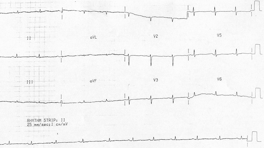 ECG restrictive cardiomyopathy, low QRS voltage, flattened T waves