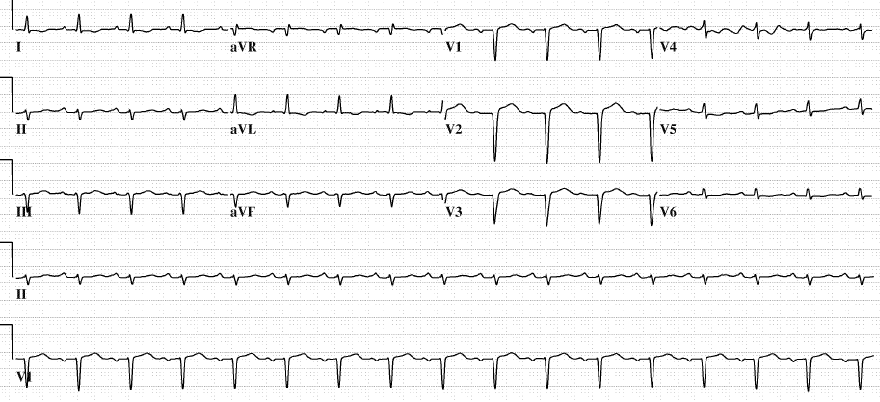 ECG restrictive cardiomyopathy, low voltage QRS complexes, non-specific ST T wave changes, pathological Q waves