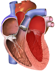 restrictive cardiomyopathy overview