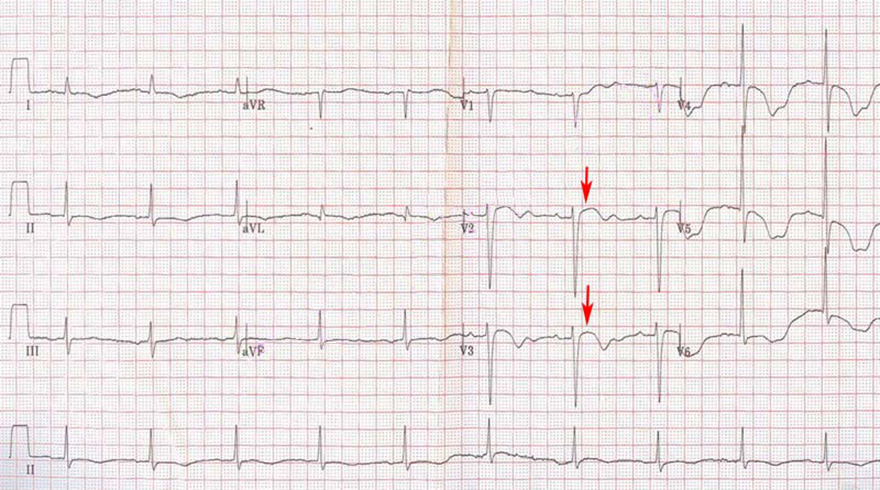 ECG Broken heart syndrome, takotsubo cardiomyopathy, Stress cardiomyopathy, Apical ballooning syndrome
