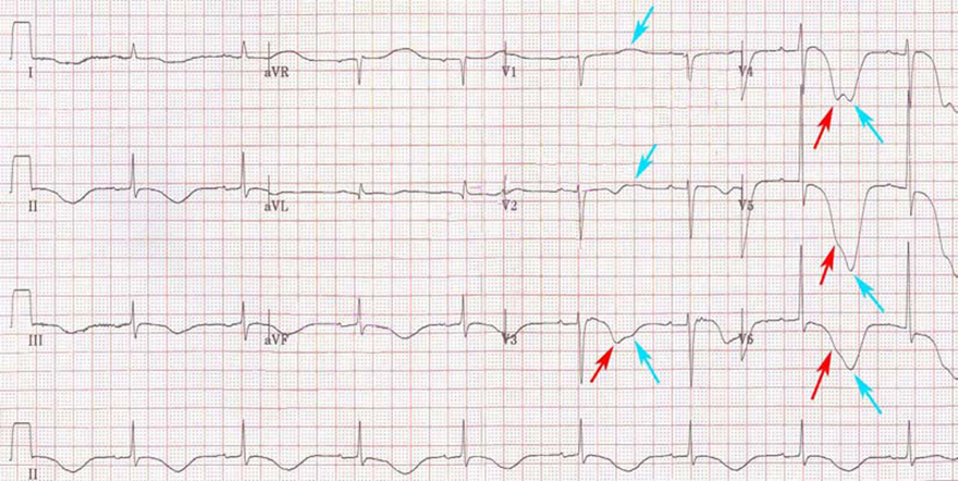 ECG takotsubo cardiomyopathy, Broken heart syndrome, Stress cardiomyopathy, Apical ballooning syndrome, The Octopus Trap