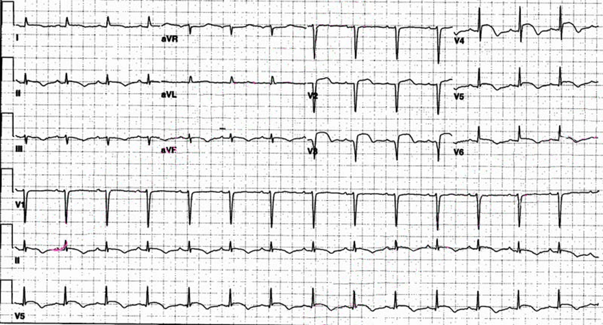 ECG tako tsubo, broken heart syndrome, stress cardiomyopathy, The Octopus Trap