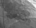 Takotsubo cardiomyopathy ventriculogram