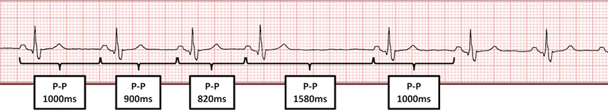 ECG second degree sa block, type I, wenckebach vs. type II
