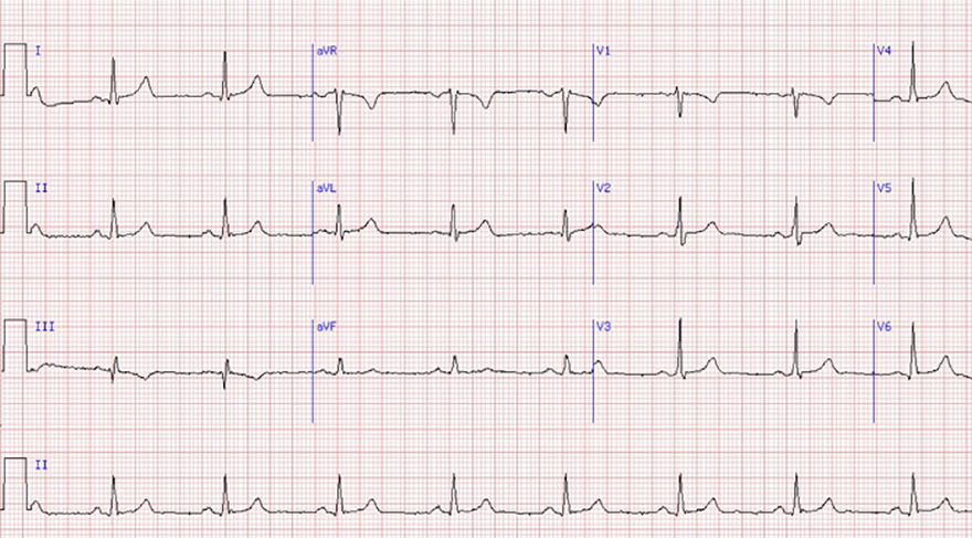 ECG sinus rhythm vs. SA exit block