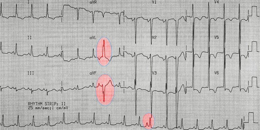 ECG normally and aberrantly conducted premature atrial complexes