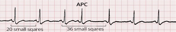 ECG Premature atrial complex and non-compensatory pause