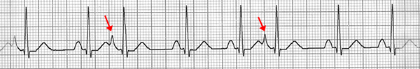 Premature Atrial Complex PAC ECG