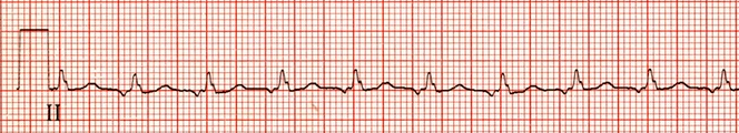 ECG Unifocal atrial tachycardia, abnormal P wave morphology