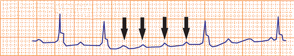 ECG carotid sinus massage, uni-focal atrial tachycardia, abnormal P waves morphology